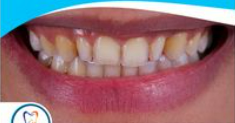לפני ואחרי טיפול הלבנת שיניים
