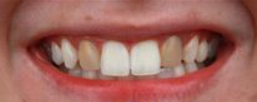 לפני ואחרי טיפול הלבנת שיניים