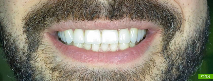 לפני ואחרי ציפוי שיניים חרסינה