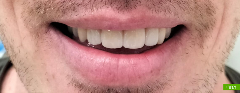 לפני ואחרי ציפוי שיניים חרסינה