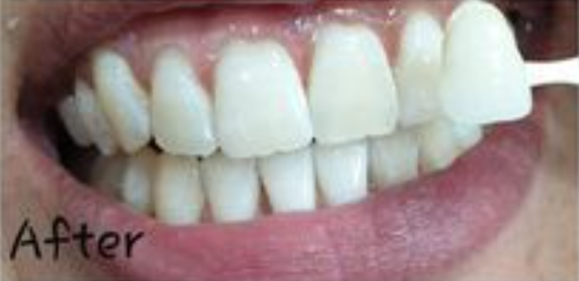 לפני ואחריי הלבנת שיניים