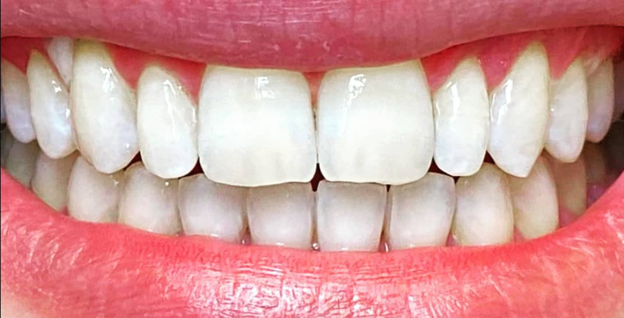 לפני ואחרי הלבנת שיניים