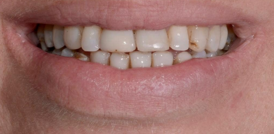 לפני ואחרי ציפוי שיניים