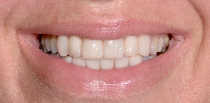 לפני ואחרי ציפוי שיניים