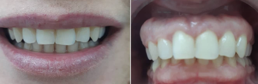 לפני ואחרי יישור שיניים