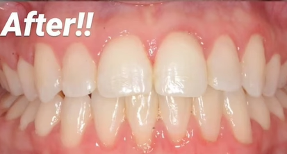 יישור שיניים לפני ואחרי