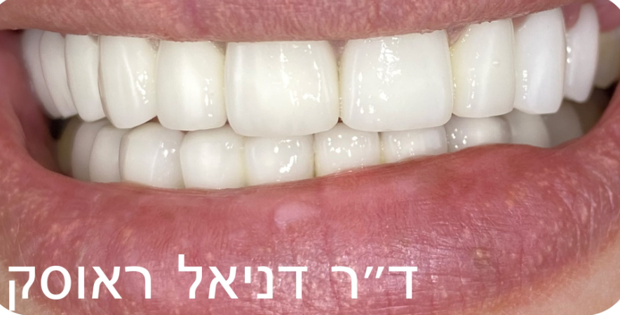 לפני ואחרי ציפויי שיניים
