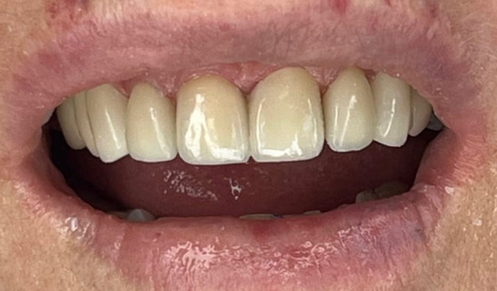 לפני ואחרי ציפויי שיניים אימקס