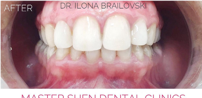 ציפויים בשיניים לפני  ואחרי