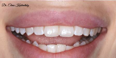 שיקום אסתטי של השיניים הקדמיות העליונות באמצעות קומפוזיט