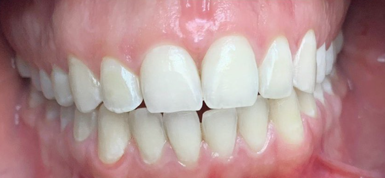 הלבנת שיניים לפני ואחרי