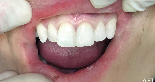השלמת שן שבורה לפני ואחרי