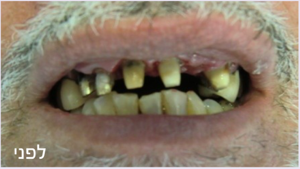 השתלת שיניים לסת עליונה לפני ואחרי 