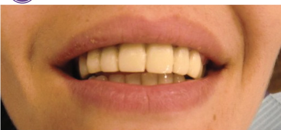 לפני ואחרי השתלת שיניים לסת עליונה