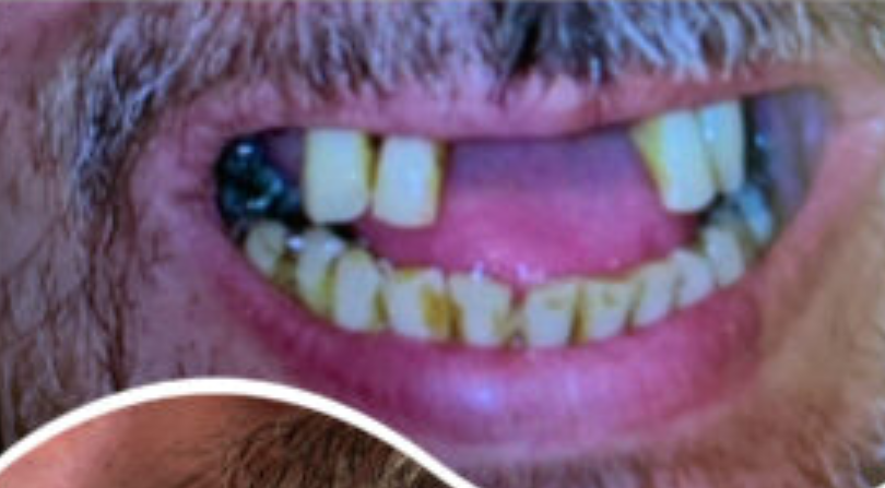 לפני ואחרי השתלת שיניים קדמיות