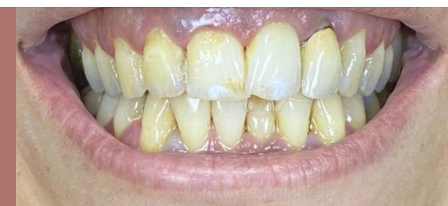 לפני ואחרי השתלות שיניים
