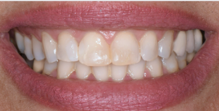 ביצענו טיפולים משמרים וציפויי חרסינה ב3 שיניים קדמיות.