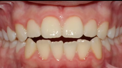 יישור שיניים לפני ואחרי