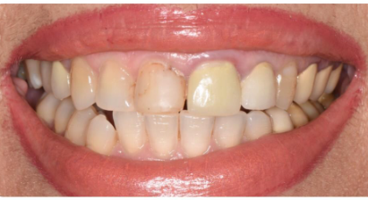 ציפוי על השיניים העליות קדמיות ציפוי למינייט העשוי משכבה דקה של חרסינה