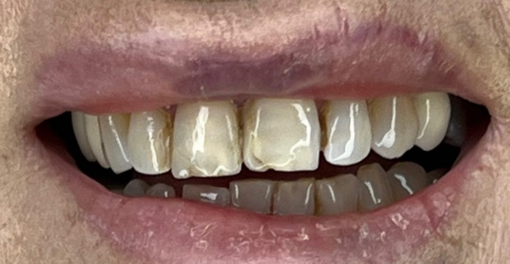 לפני ואחרי ציפויי שיניים אימקס