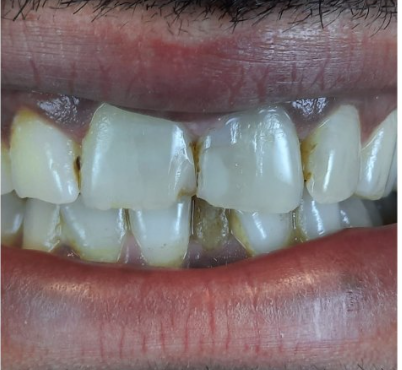 ציפויי שיניים חרסניה