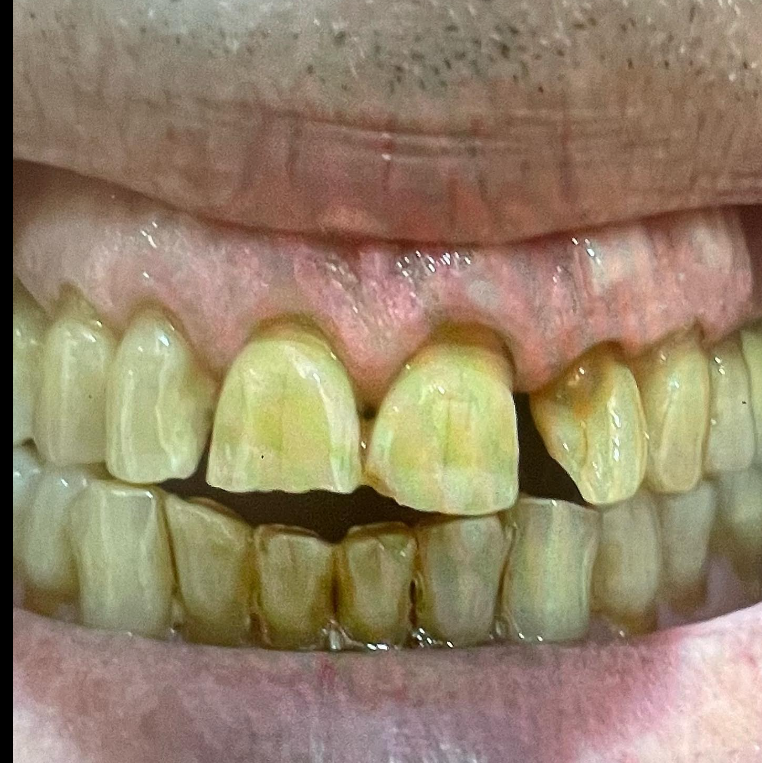 לפני ואחרי ציפויי שיניים