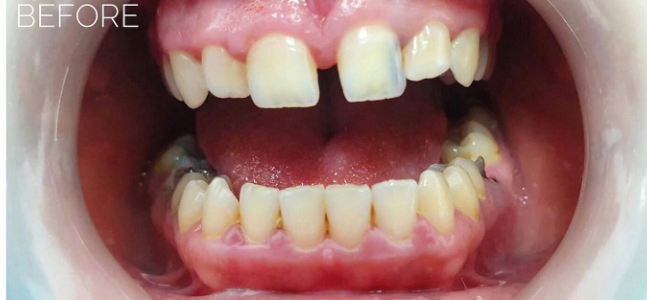 ציפויים בשיניים לפני  ואחרי