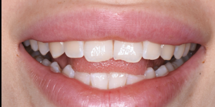 שיקום אסתטי של השיניים הקדמיות העליונות באמצעות קומפוזיט