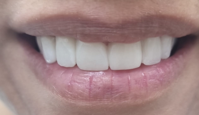 ציפויי שיניים לפני ואחרי 