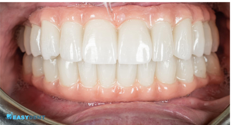 לפני ואחרי השתלות שיניים 