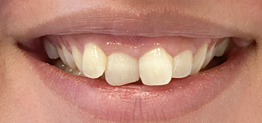 ציפוי שיניים חרסינה לפני ואחרי