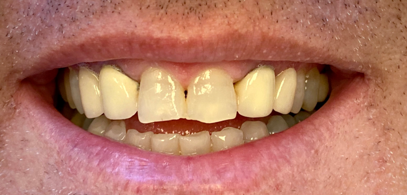 ציפוי שיניים חרסינה לפני ואחרי